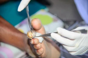 Surgical Debridement